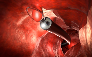 Cirurgia de Polipectomia
